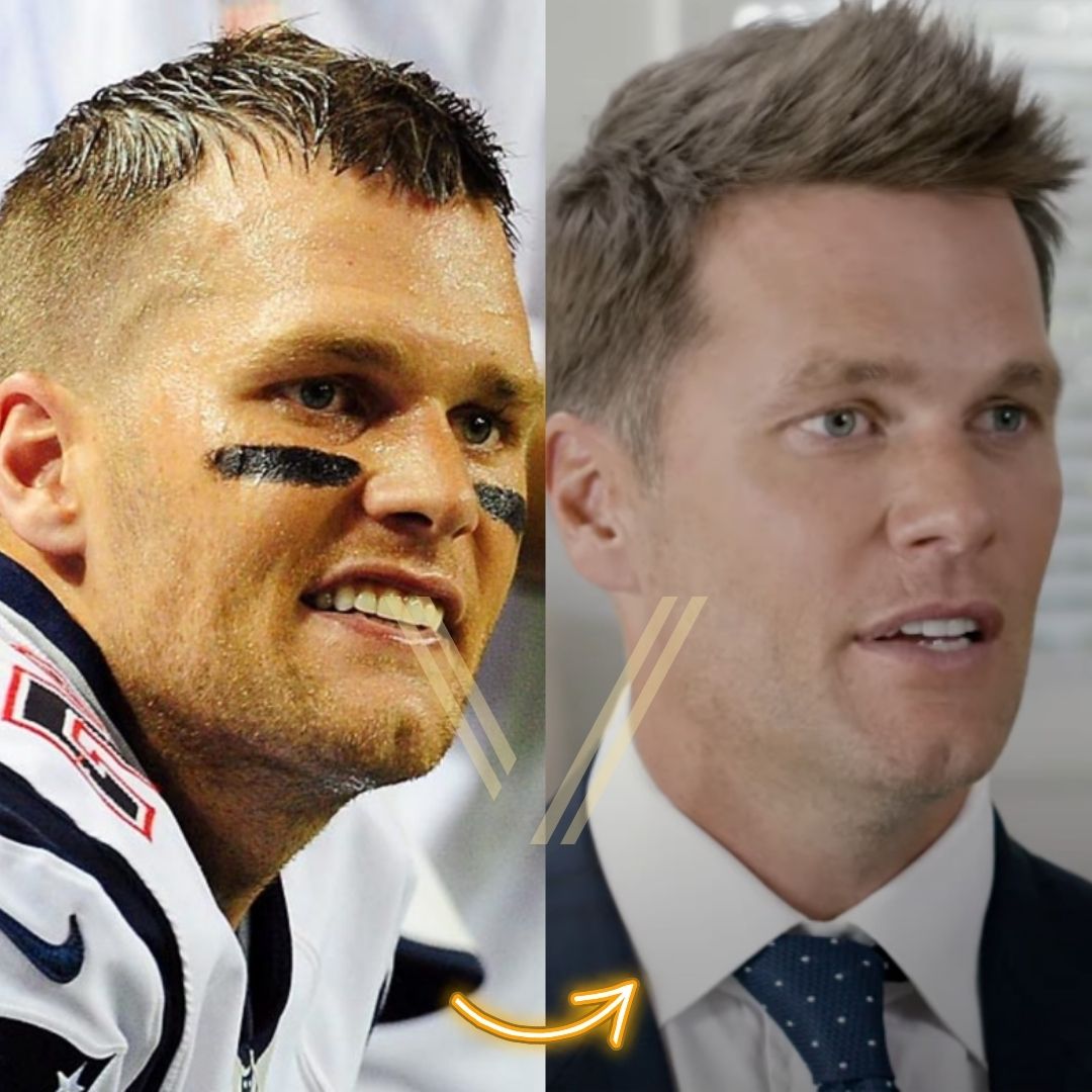 Tom Brady Hair Transplant: Before and After Transformation