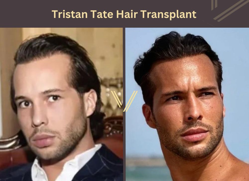 tristan tate hair transplant before after