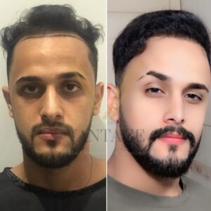1000 grafts hair transplant before after result