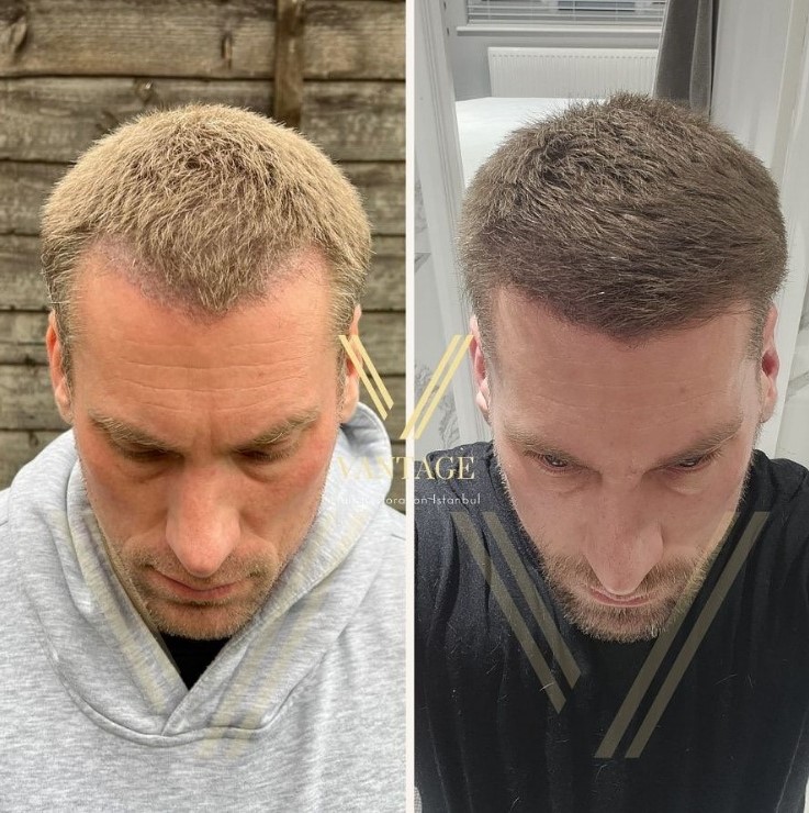 1000 grafts hair transplant before after