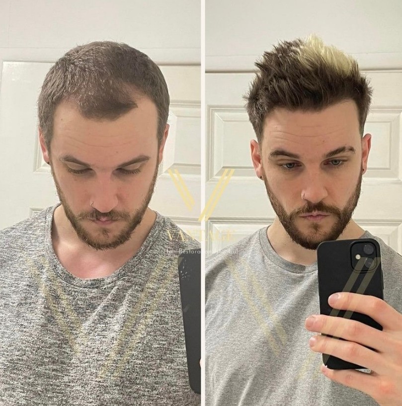 1000 grafts hair transplant before and after