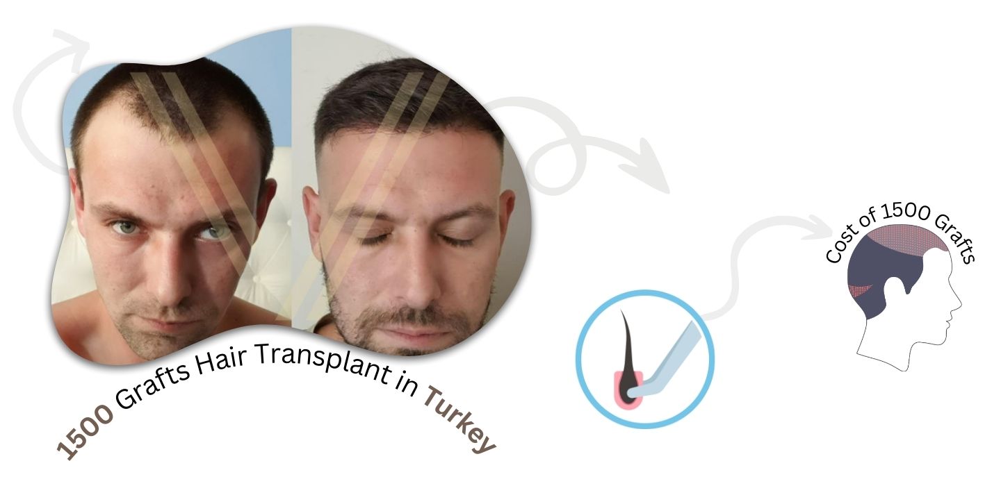 1000 Grafts Hair Transplant in Turkey