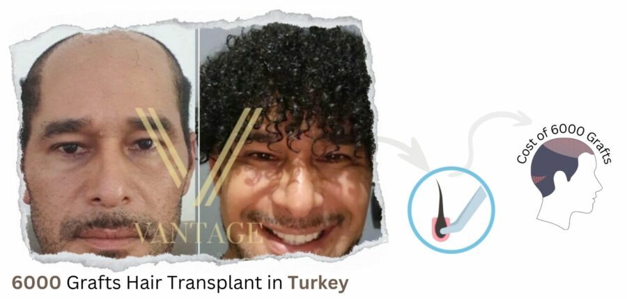 6000 Grafts Hair Transplant in Turkey