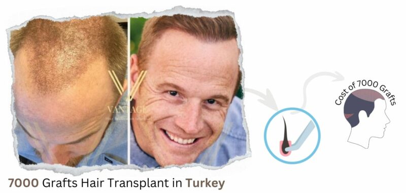 7000 Grafts hair transplant Turkey