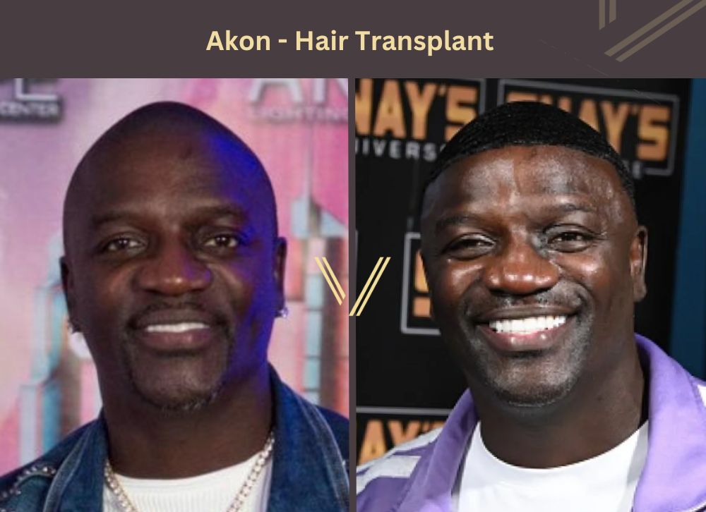 akon hair transplant before after