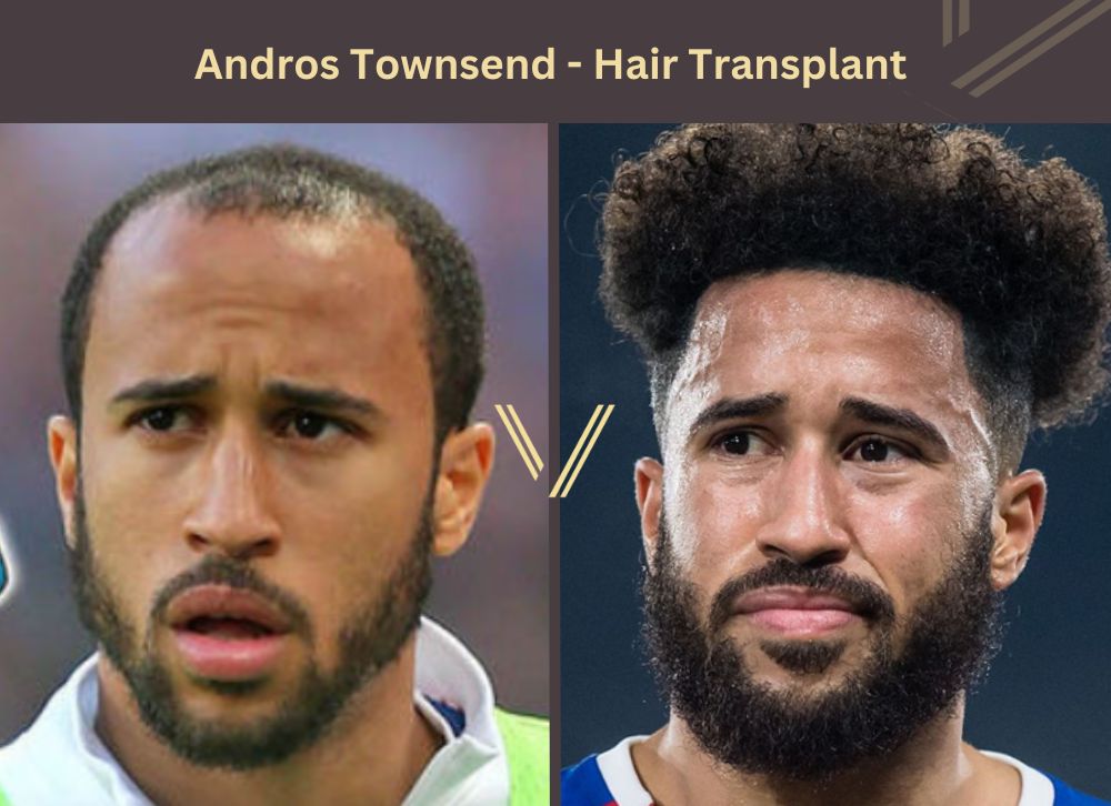 andros townsend hair transplant before after