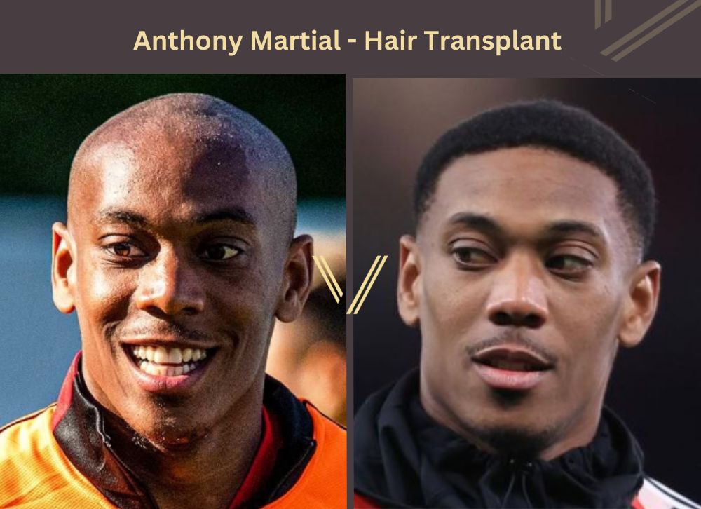 anthony martial hair transplant before after