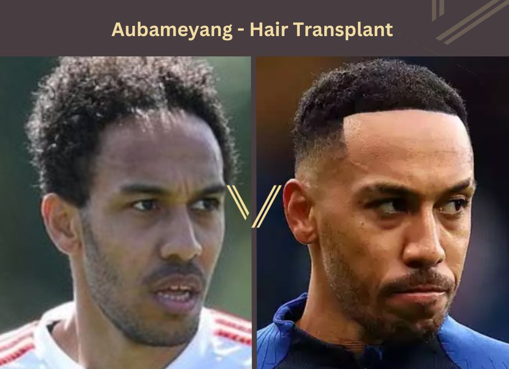 aubameyang hair transplant before after