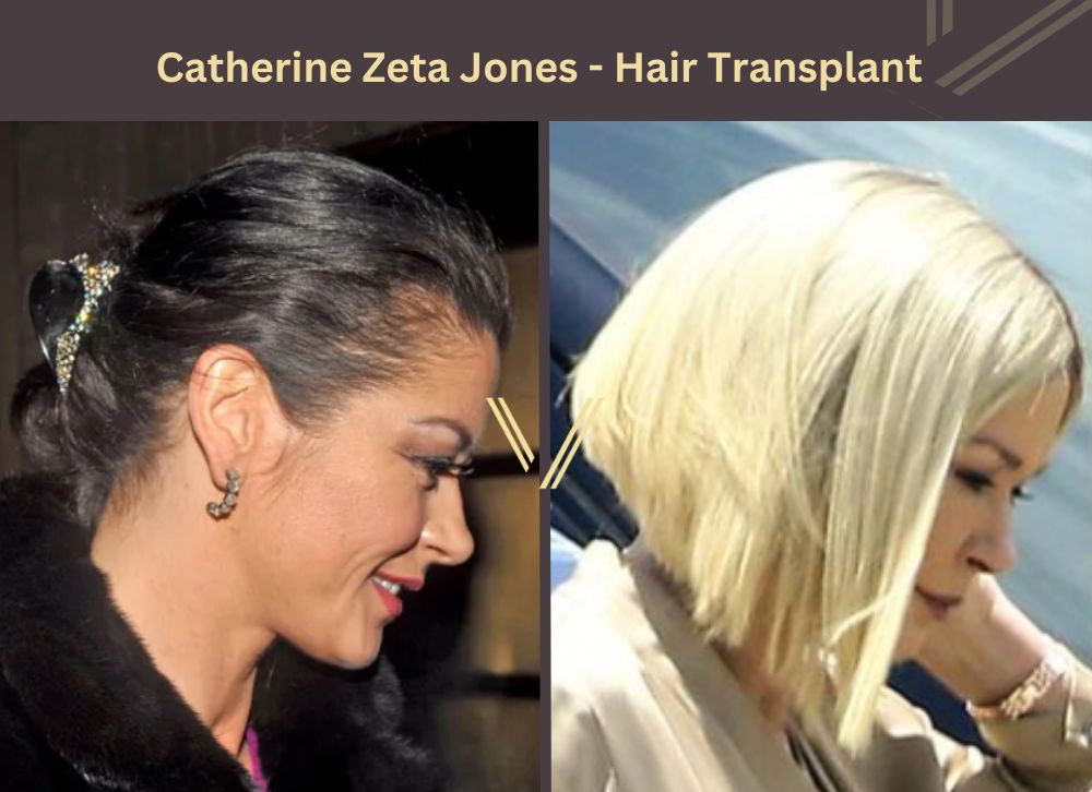 Catherine zeta jones hair transplant
