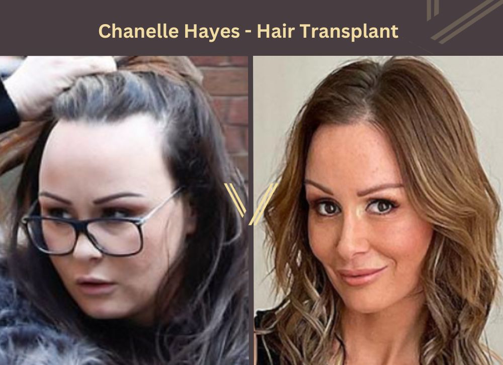 Chanelle Hayes Hair Transplant Before and After