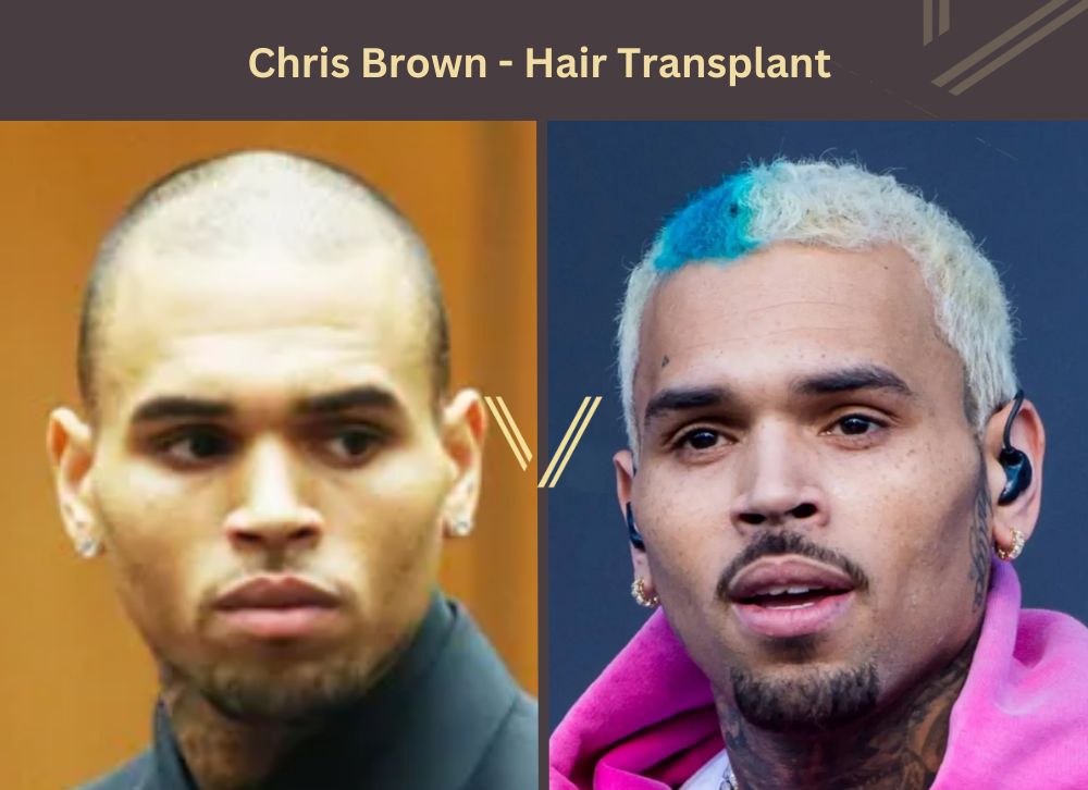 chris brown hair transplant before after