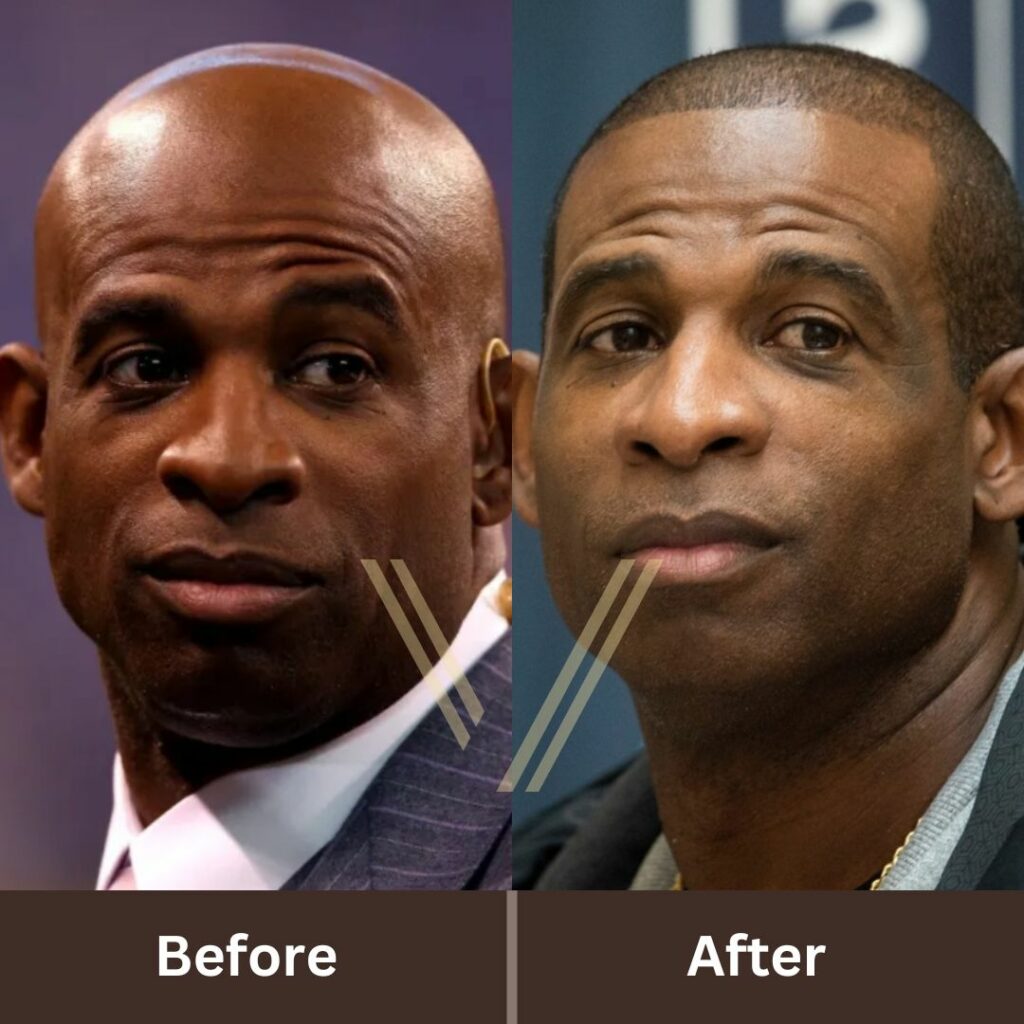 Deion Sanders' Hair Transplant: Before and After Transformation