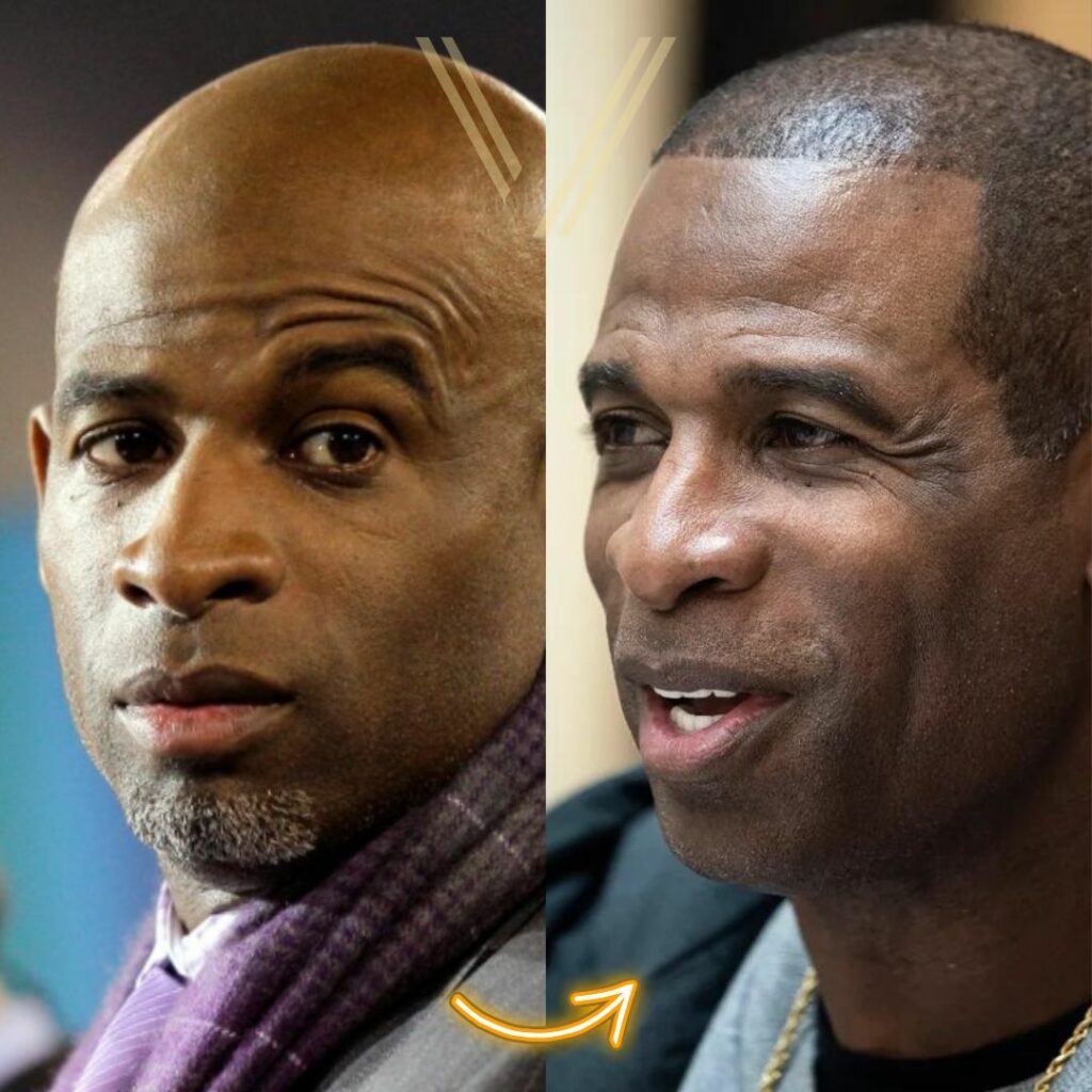 Deion Sanders' Hair Transplant: Before And After Transformation