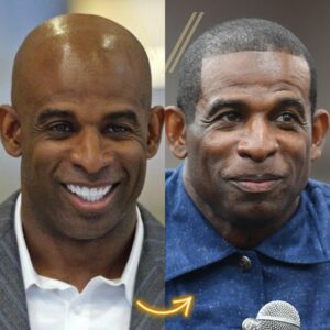 deion sanders hair transplant before and after result