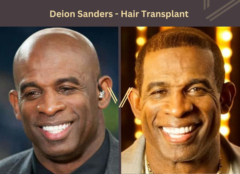 deion sanders hair transplant before after