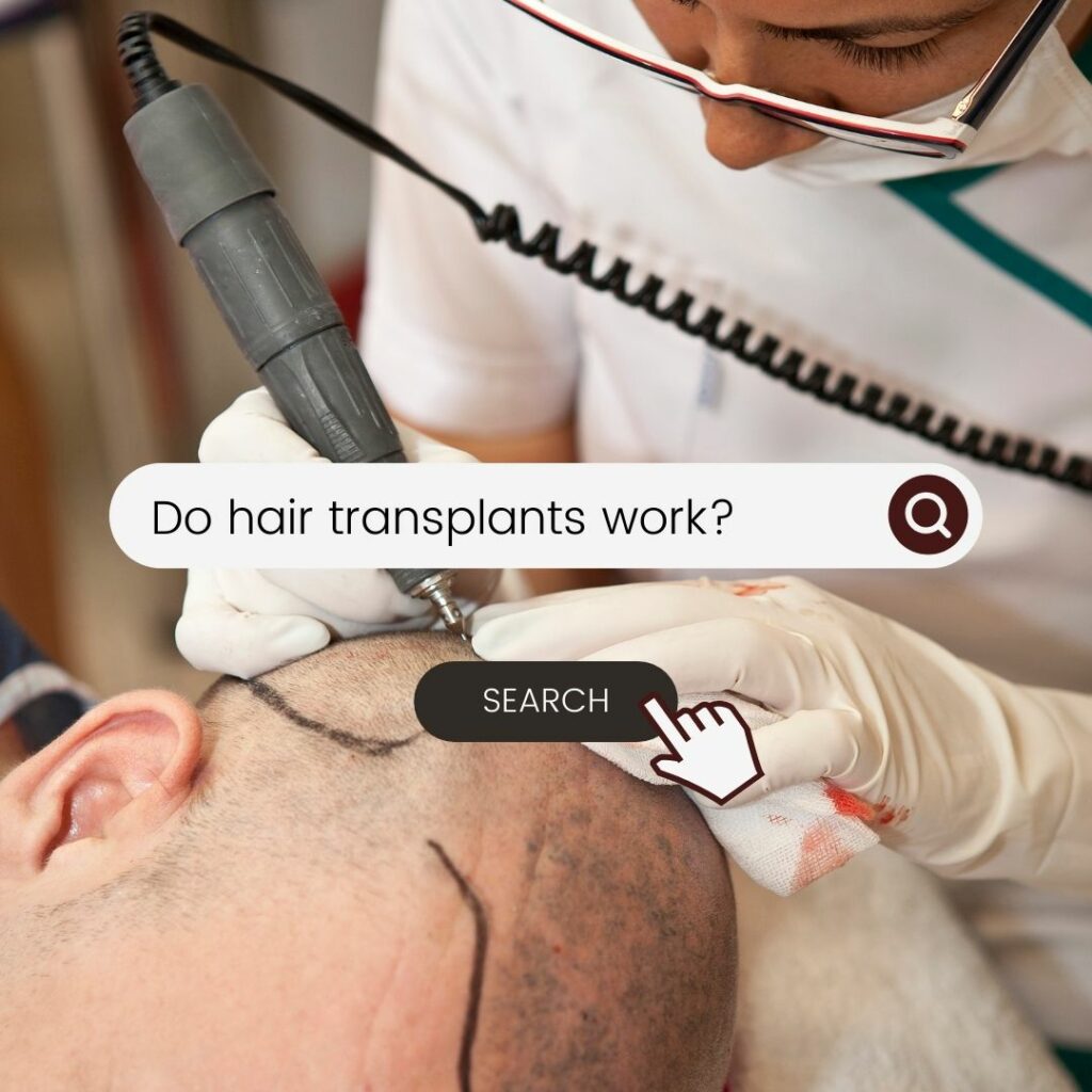 do hair transplants work