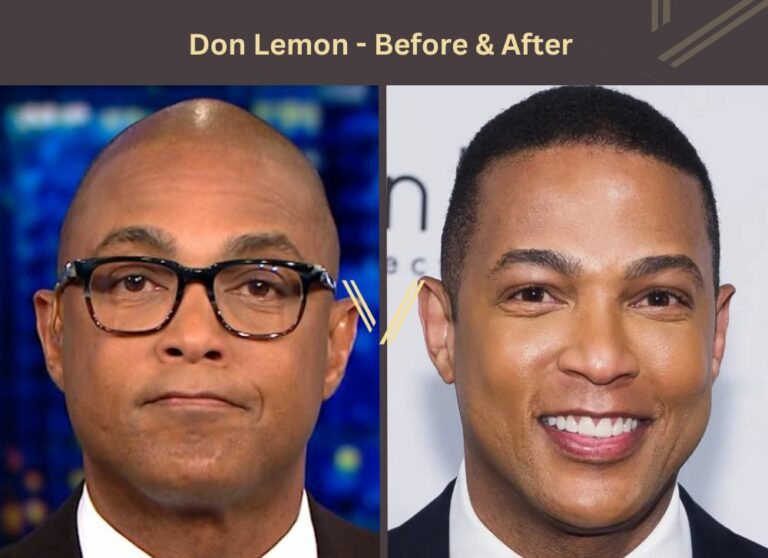 Black Celebrity Hair Transplant - 27 Before & After Photos