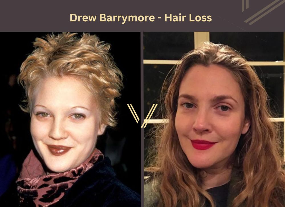 Drew Barrymore hair transplant Before and After