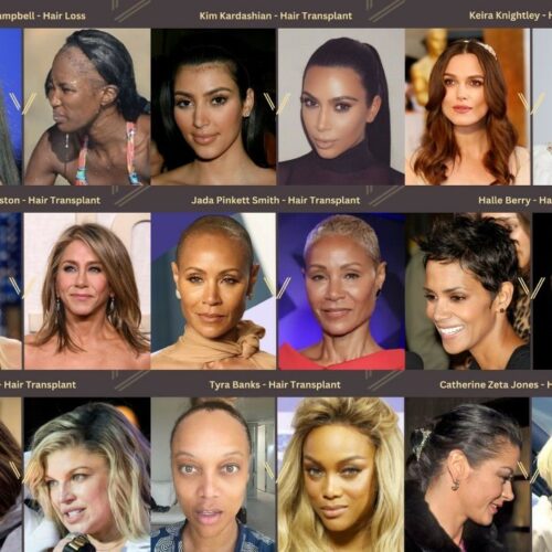 Female Celebrity Hair Transplant before and after