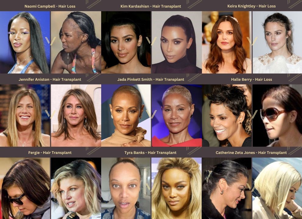 Female Celebrity Hair Transplant before and after