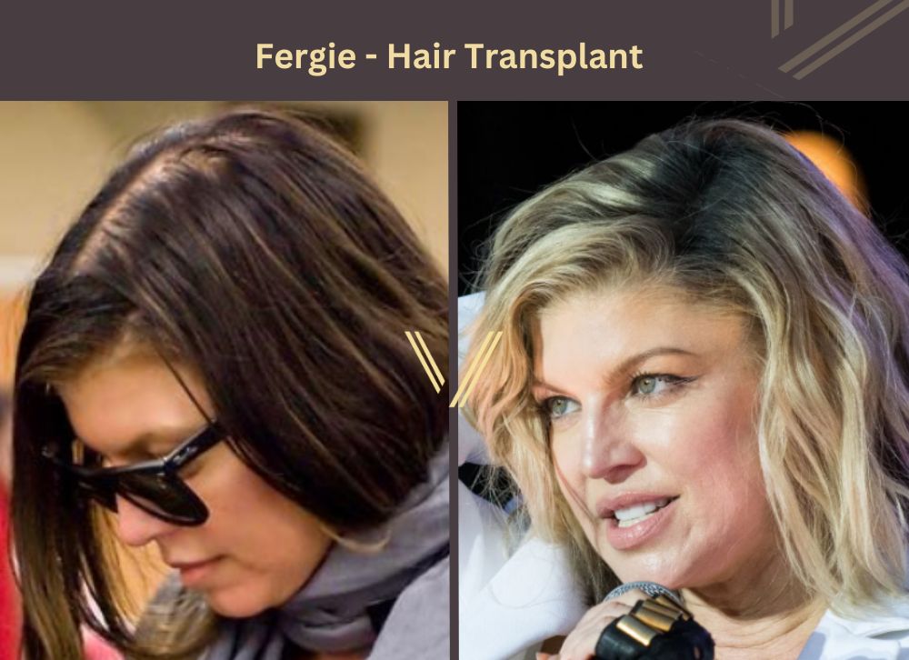 Fergie Hair Transplant Before and After