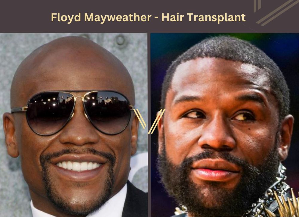 floyd mayweather hair transplant before after