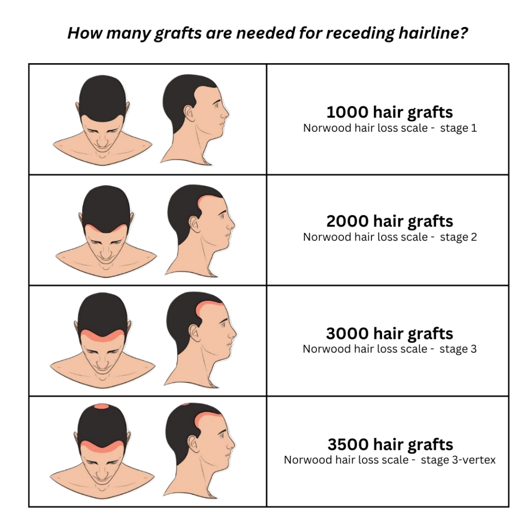 grafts needed for receding hairline hair transplant