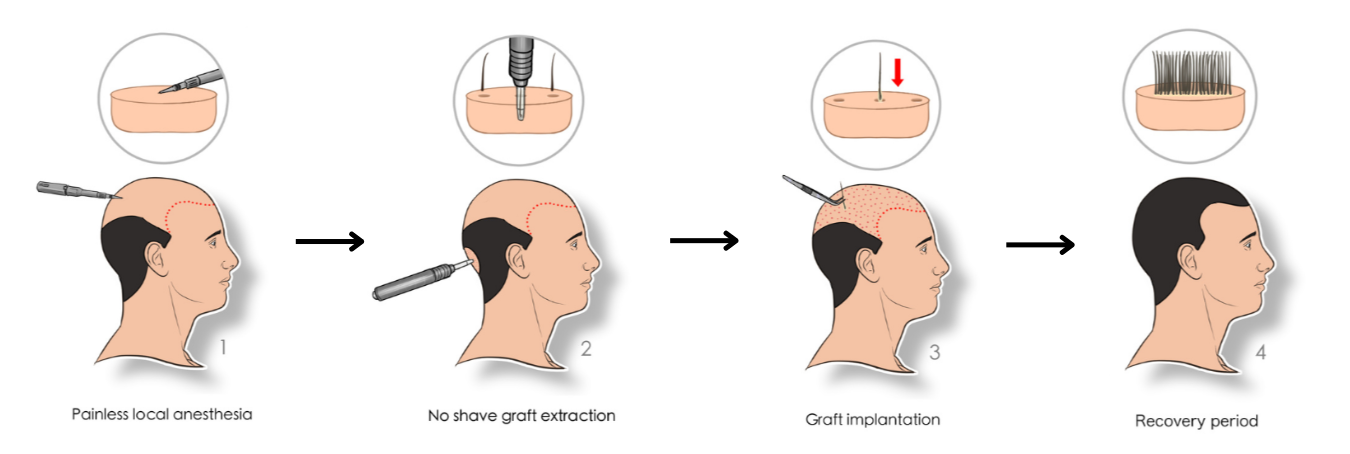 hair grafting working procedure