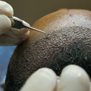 hair transplant cause trypophobia