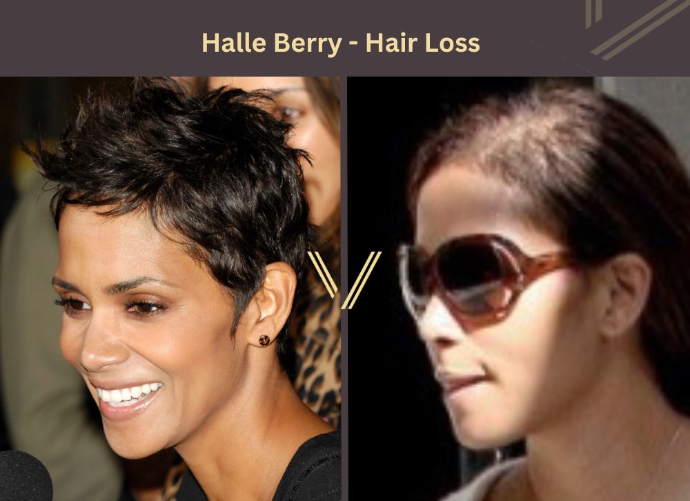 Halle Berry Hair Transplant Before and After