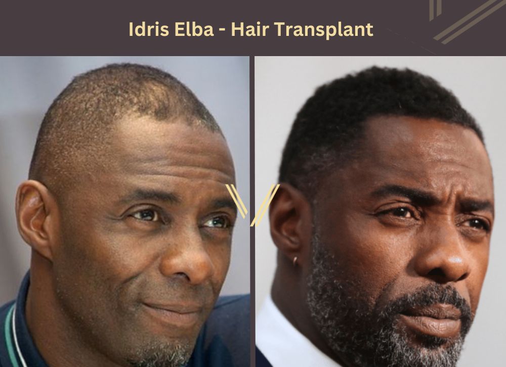 idris elba hair transplant before after
