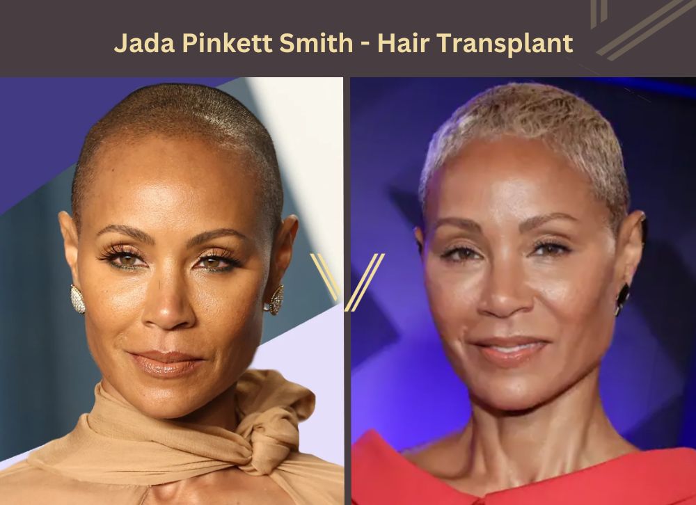 Jada Pinkett smith hair transplant Before and After