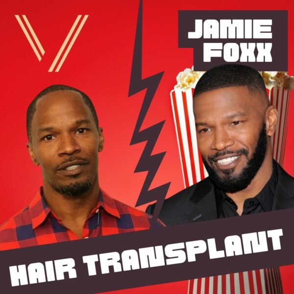 jamie foxx hair transplant