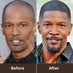 jamie foxx hair transplant before after 