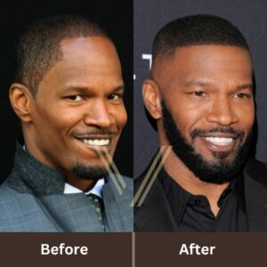 jamie foxx hair transplant before after result