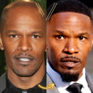 jamie foxx hair transplant before after transformation
