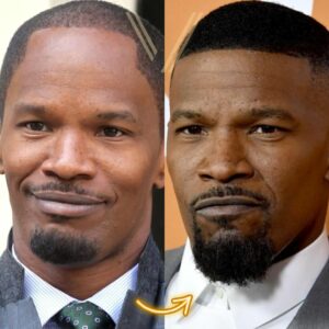 jamie foxx hair transplant before and after