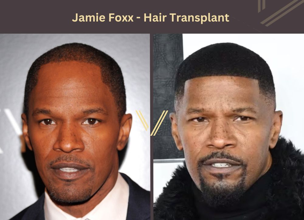 jamie foxx hair transplant before after