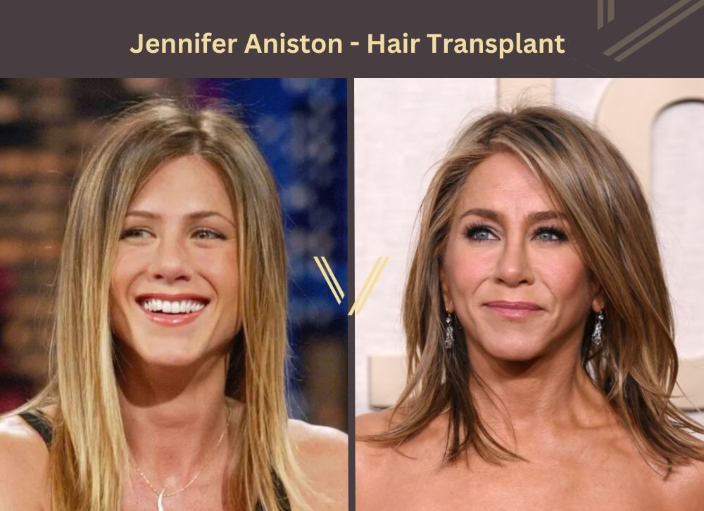 Jennifer Aniston Hair Transplant Before and After