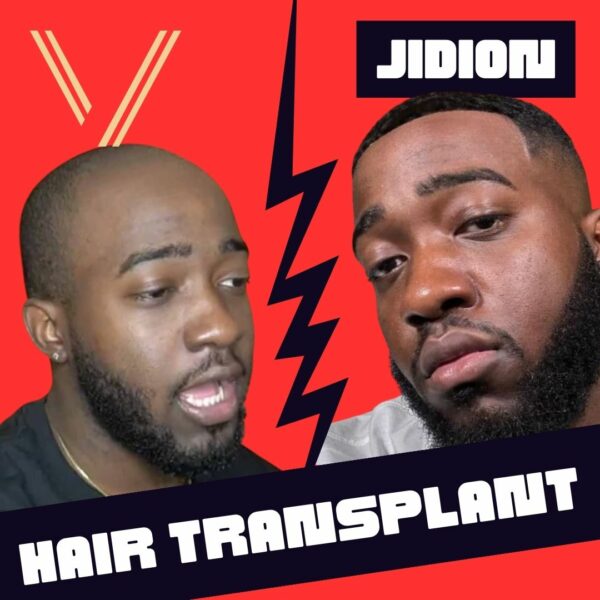 jidion hair transplant
