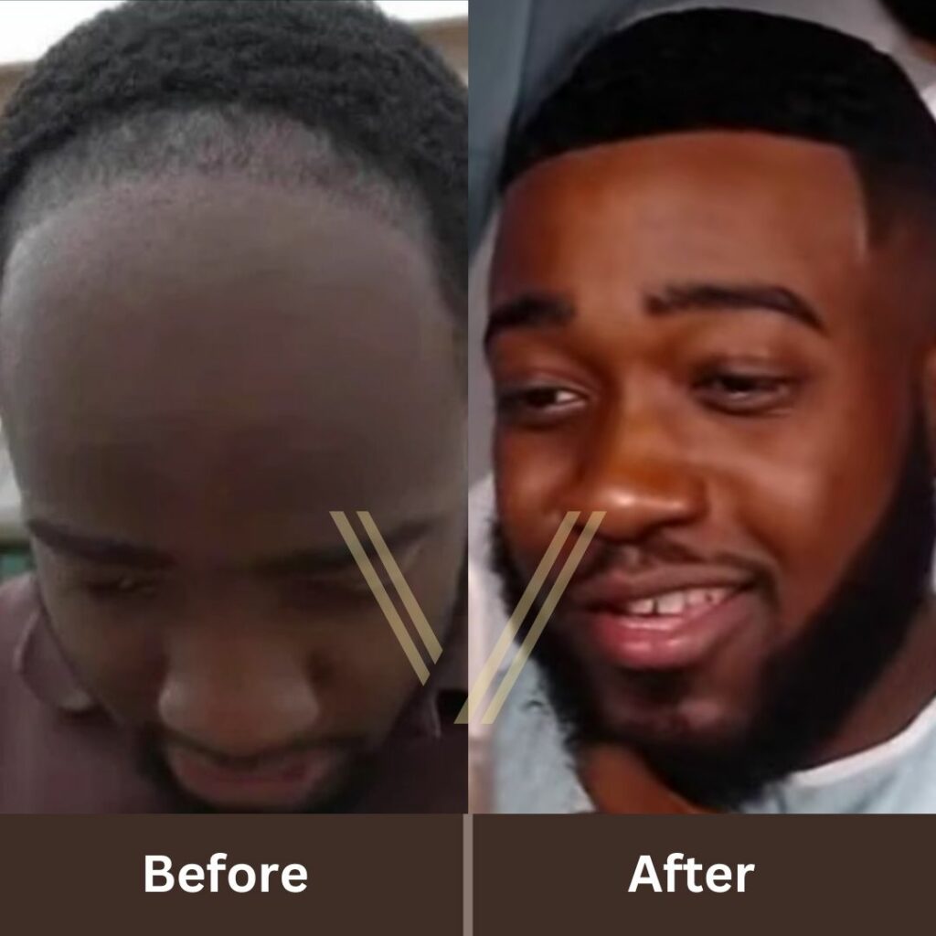 JiDion Hair Transplant: Before and After Transformation