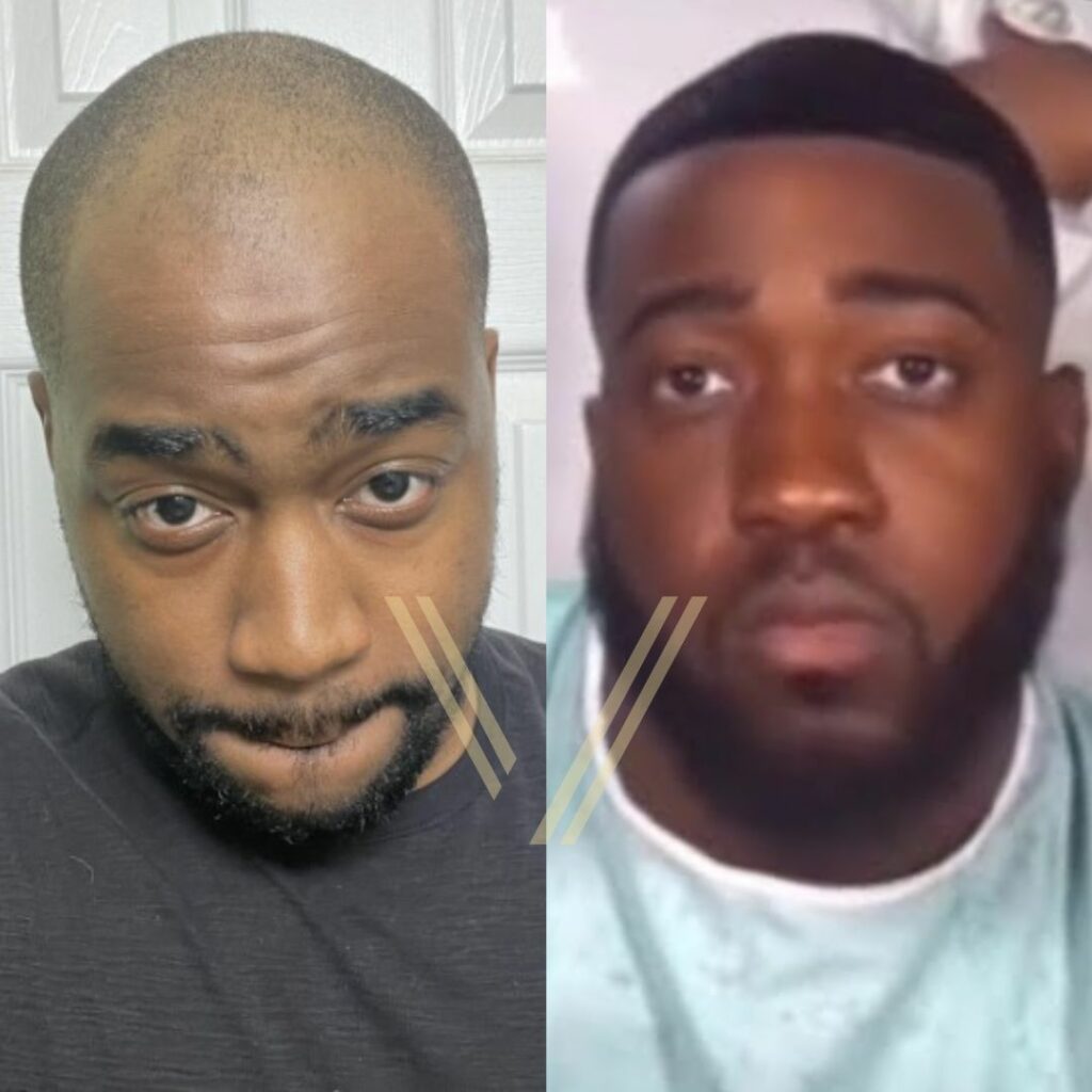 JiDion Hair Transplant: Before and After Transformation