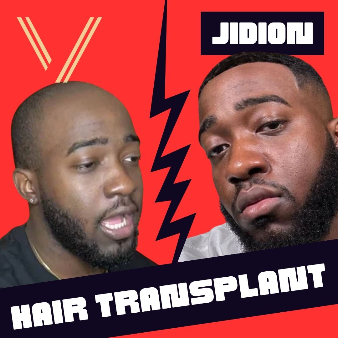 JiDion Hair Transplant: Before and After Transformation