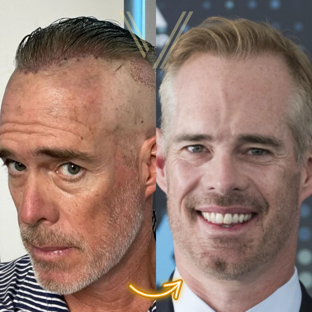 Joe Buck Hair Transplant Before and After