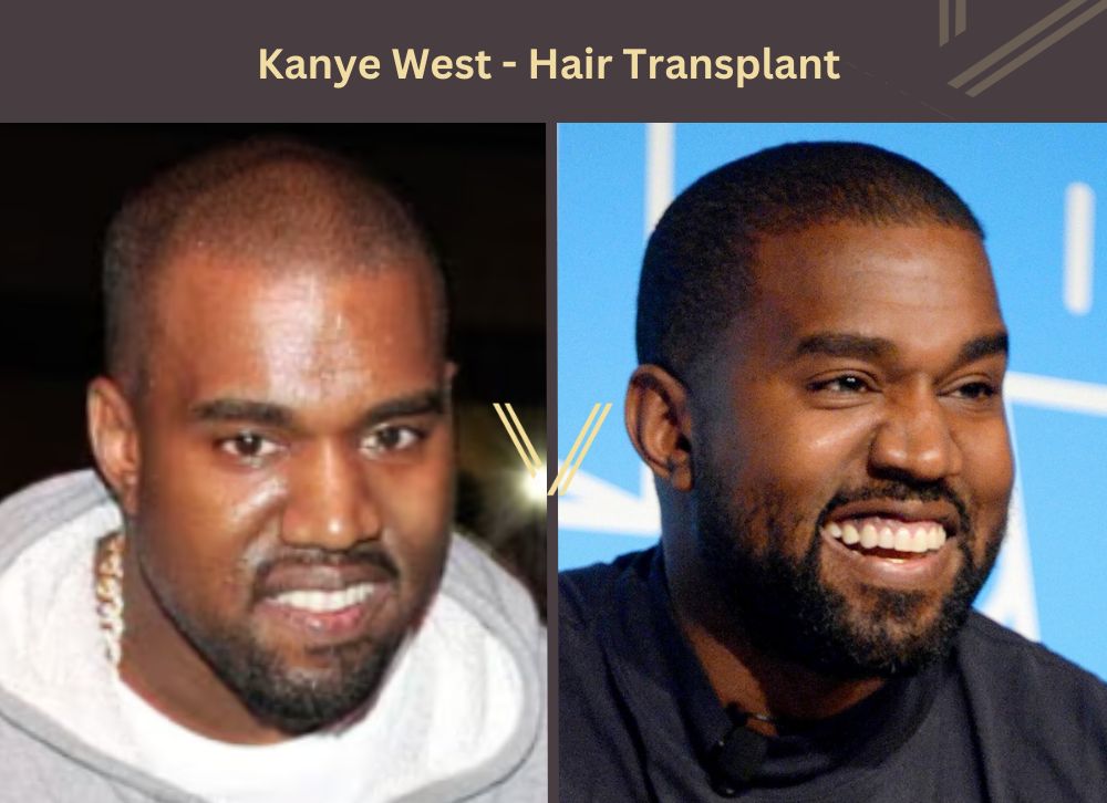 kanye west hair transplant before after