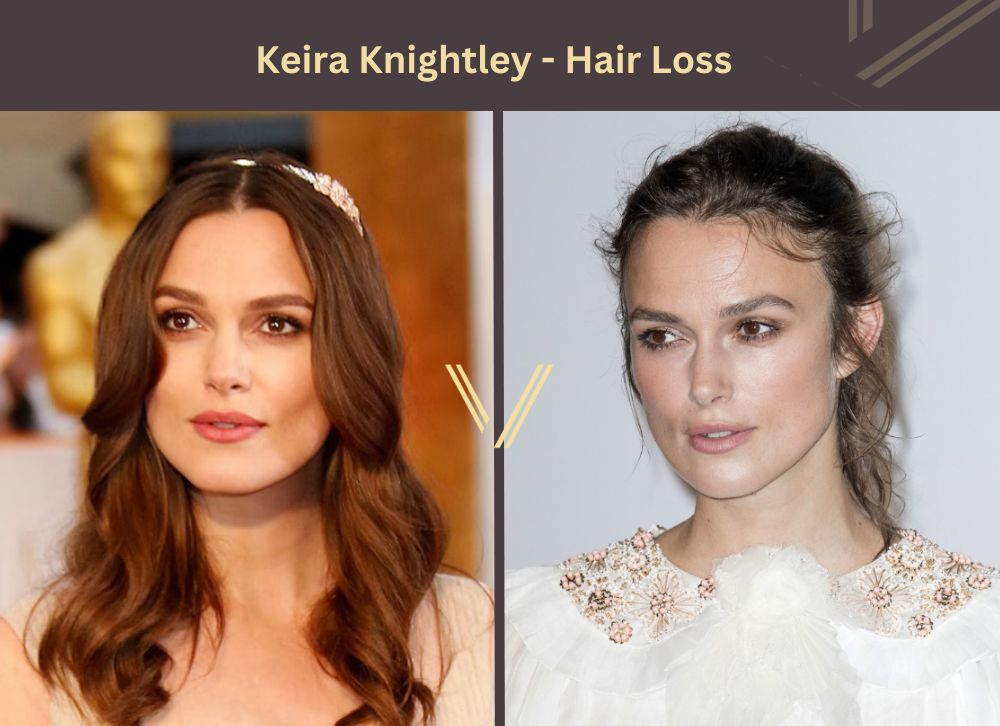 Keira Knightley Hair Transplant Before and After
