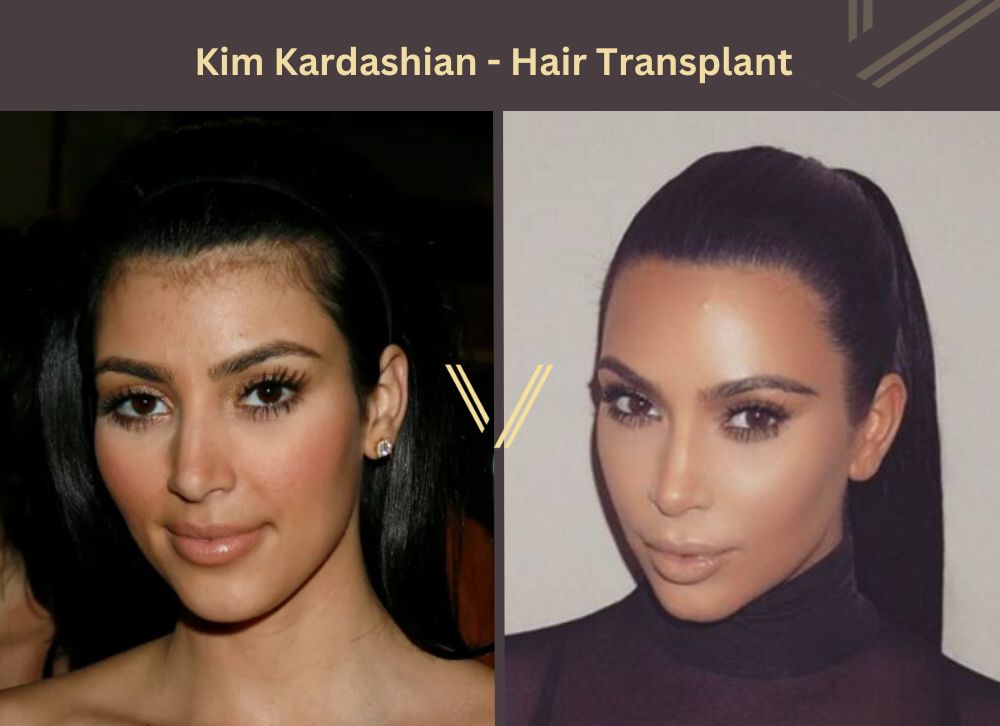 Kim Kardashian Hair Transplant Before - After