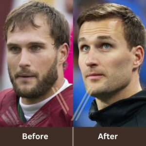 kirk cousins hair tranplant before after