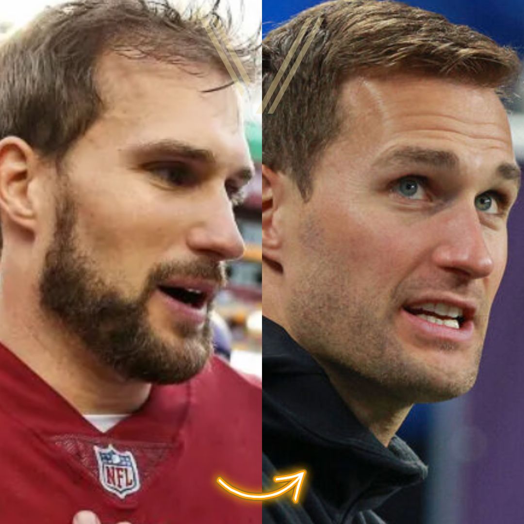 Kirk Cousins' Hair Transplant: Before and After Transformation