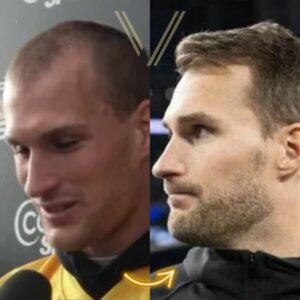 kirk cousins hair tranplant before and after result